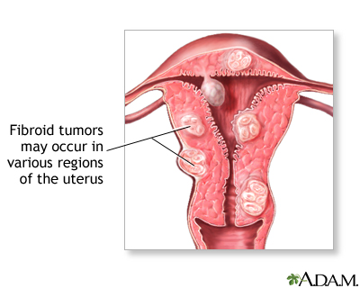 Uterine Fibroids