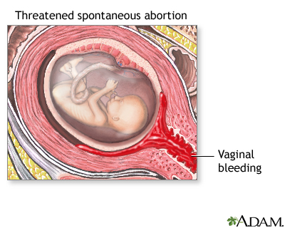 Pregnancy Health Center - Early Miscarriage