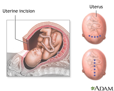 C-Section Uterine Incision 5