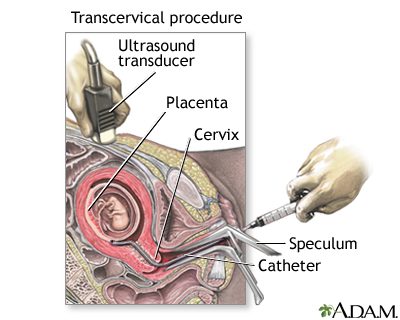 Chorionic Villus Sampling
