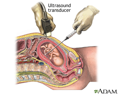 Percutaneous Umbilical Cord Blood Sampling