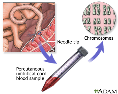 Percutaneous Umbilical Cord Blood Sampling