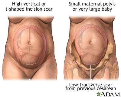 Pregnancy Health Center - Vaginal Birth After C-Section (VBAC)
